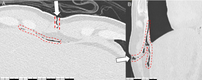 A rare complication of a thoracic wound: the pneumopericardium?