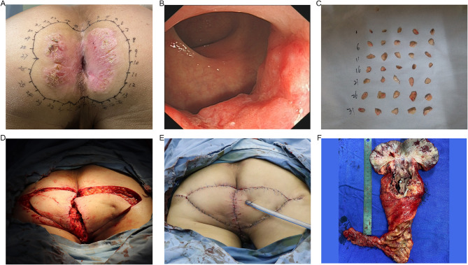 Secondary Perianal Paget's Disease Originating From Adenocarcinoma of the Anorectal Junction: A Case Report.