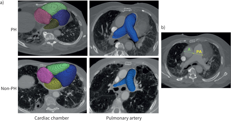 Detection of pulmonary hypertension in idiopathic pulmonary fibrosis using random forest models and automated measures of central computed tomography structures.