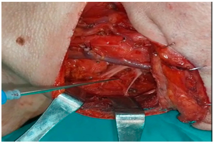 Motor Innervation of the Trapezius by Cervical Sensitive Nerves: An Intraoperative Neuromonitoring Study and Postoperative Functional Outcomes.