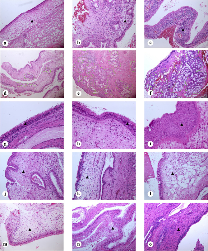 Histopathological Characteristics of Nasal Tissues From Paediatric Patients with Chronic Rhinosinusitis and Nasal Polyps Requiring Revision Surgery.