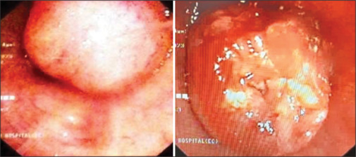 Bronchoscopic management of endobronchial hamartomas using "hot and cold" therapies - Initial experience in two patients.
