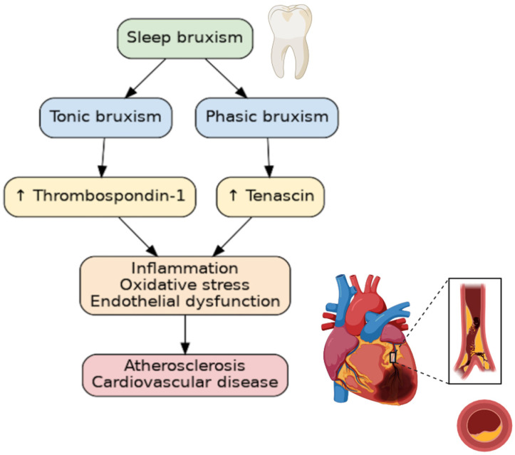 Tenascin-C and Thrombospondin-1 as a Potential Link Between Sleep Bruxism and Cardiovascular Diseases-A Case-Control Study.