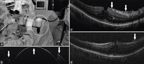 Intraoperative optical coherence tomography in ophthalmology: Technologies and applications.