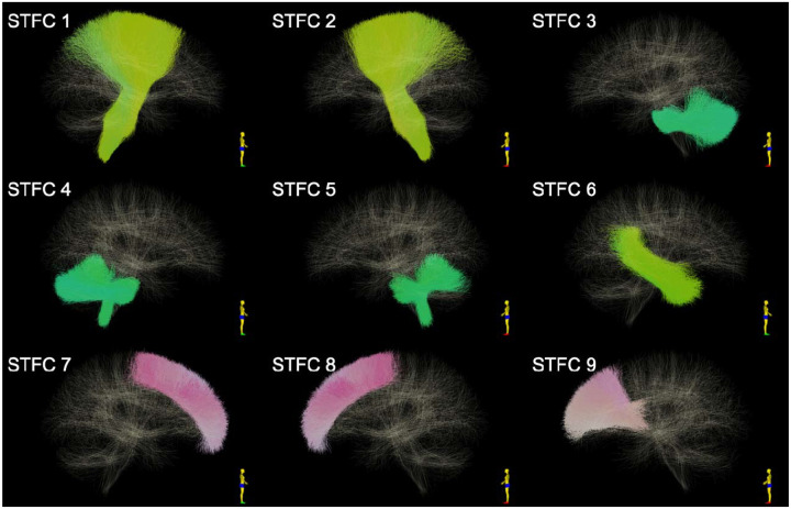 Study of Sex Differences in the Whole Brain White Matter Using Diffusion MRI Tractography and Suprathreshold Fiber Cluster Statistics.