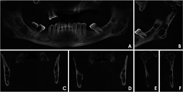 Cone-beam computed tomography-based analysis of jawbone destruction patterns in multiple myeloma: Associations with clinical data in an observational study.