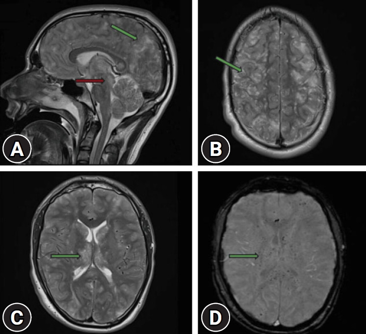 Fatal fat embolism syndrome in a young trauma patient with a stable initial presentation: time to define predictive criteria? A case report.