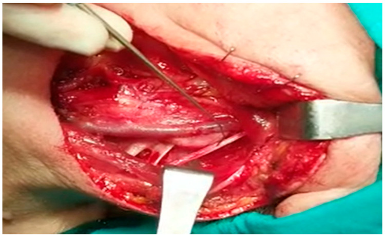Motor Innervation of the Trapezius by Cervical Sensitive Nerves: An Intraoperative Neuromonitoring Study and Postoperative Functional Outcomes.