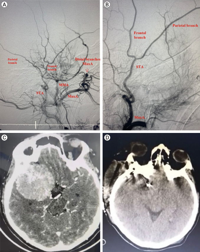 Preoperative embolization of brain, head, and neck tumors: Single center experience and literature review.