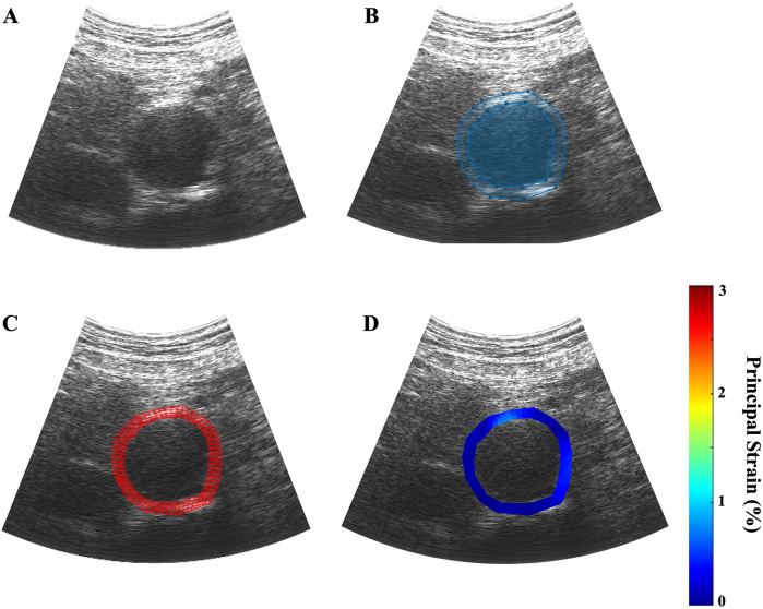 Characterizing changes in abdominal aortic aneurysms using principal wall strain ultrasound elastography.