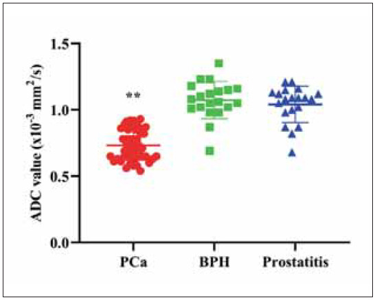 Combination of prostate cancer antigen 3 (PCA3), sarcosine, glypican-1 (GPC1), urokinase plasminogen activator receptor (uPAR), and thymidine kinase 1 (TK1), and T2WI and DWI radiomics model for distinguishing benign prostatic hyperplasia, prostate cancer, and prostatitis.