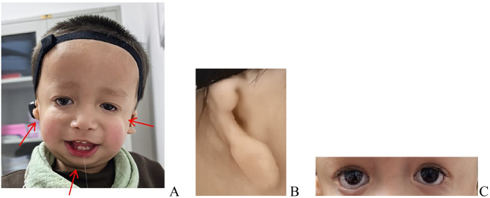 Case Report: A novel heterozygous variant of the <i>TCOF1</i> gene in Treacher Collins syndrome.