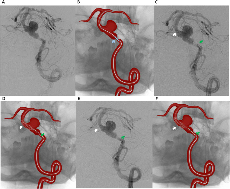 Case Report: "Stent-within-a-Stent" technique after telescopic flow diverter reconstruction for basilar artery aneurysm with proximal stenosis.