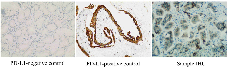 Sunvozertinib Monotherapy in Advanced Lung Adenocarcinoma with <i>EGFR</i> Exon 20 Insertion and High PD-L1 Expression: A Case Report.