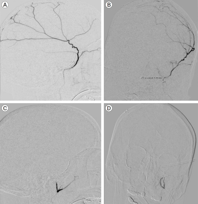 Noninferiority of coiling versus coiling with particles in middle meningeal artery embolization: A technical note and case series.