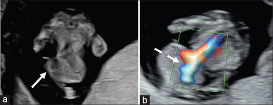 A Pattern of Malformations in the First Trimester Ultrasound.