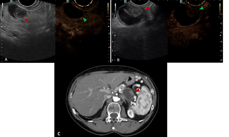Endoscopic ultrasound for pancreatic cystic lesions: a narrative review.