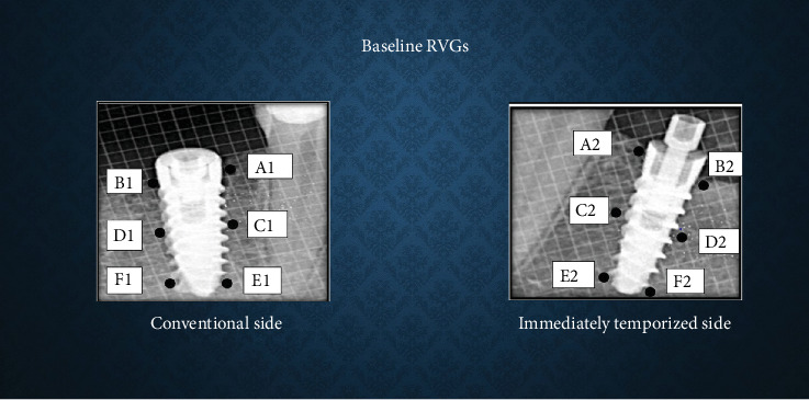 Comparison of Bone Density and Crestal Bone Loss Between Immediately Temporized and Submerged Implants in the Posterior Mandible: A Radiovisiographic Study.