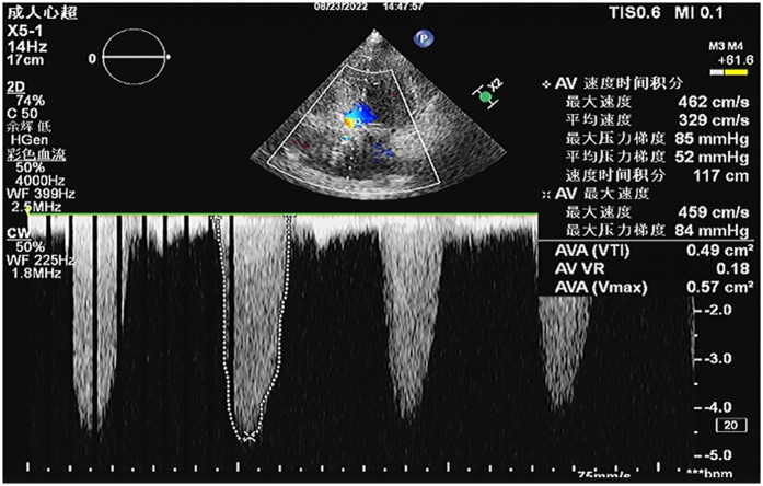 Extracorporeal membrane oxygenation-supported one-stop surgery for transcatheter aortic valve replacement and percutaneous coronary intervention in high-risk complex coronary artery and aortic valvular disease: a case report.