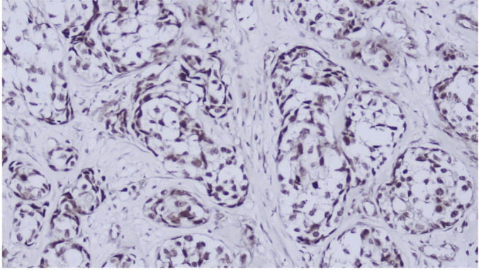 Evaluation of Tissue Expression of HMBG1 Protein in Patients With Breast Cancer.