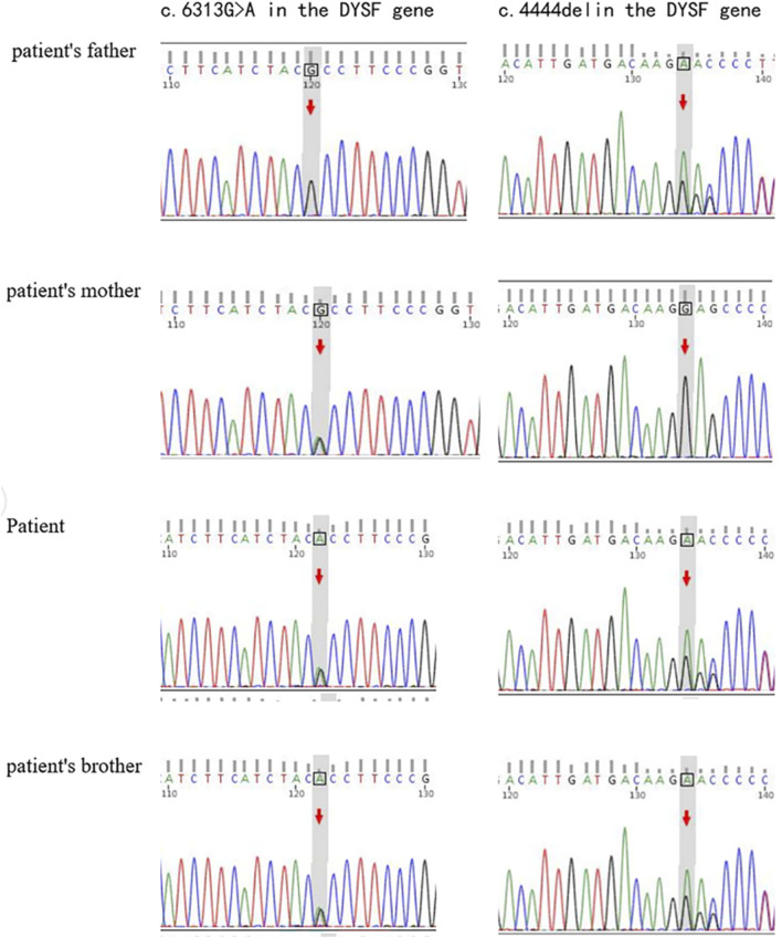 Uncovering compound heterozygous <i>DYSF</i> variants in a Chinese family affected by limb-girdle muscular dystrophy type 2B.