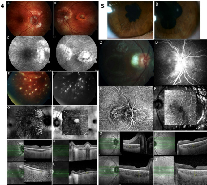 Clinical characteristics and long-term outcomes of Vogt-Koyanagi-Harada disease in pediatric age group.