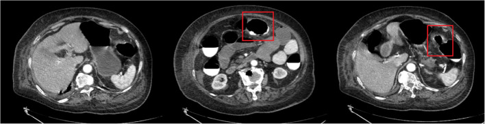 Non-enhancing bowel dilatation and secondary ileus on CT as a surgical red flag in geriatric patients with atypical presentations.