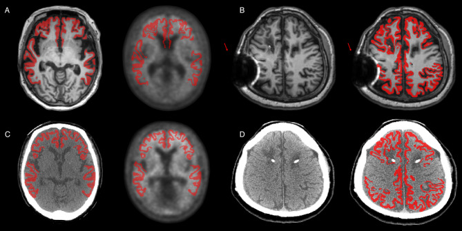 Centiloid values from deep learning-based CT parcellation: a valid alternative to freesurfer.