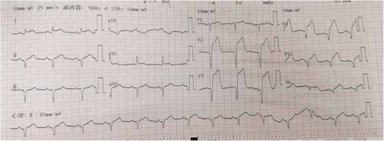 The dynamic evolution of the de Winter ECG pattern that is easily overlooked and life-threatening: a case report and literature review.