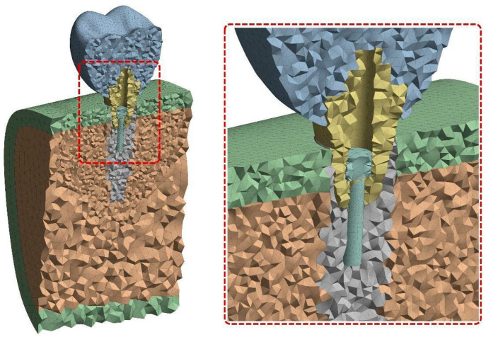 CF-PEEK vs. Titanium Dental Implants: Stress Distribution and Fatigue Performance in Variable Bone Qualities.