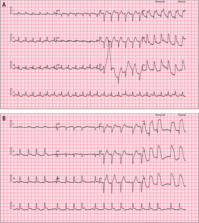 A rare coincidence of presentation of TIA like illness immediately followed by acute myocardial infarction and cardiac arrest: a case report.