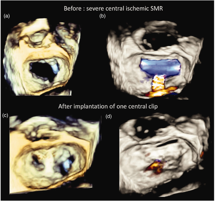 Emerging evidence on transcatheter edge-to-edge repair for secondary mitral regurgitation.