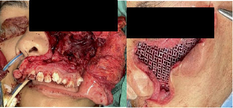 Odontogenic Fibromyxoma in a Pediatric Patient: A Rare Aggressive Neoplasm With Recurrent and Fatal Outcome.