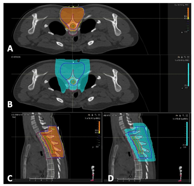 Pediatric Spinal Solitary Fibrous Tumor: A Systematic Review of a Rare Condition.