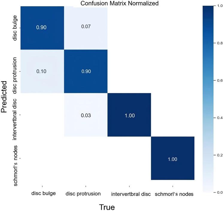 Intervertebral disc anomaly intelligent classification system based on deep learning, IDAICS.