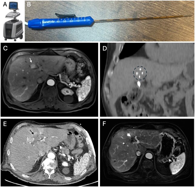 The growing armamentarium of image-guided tumor ablation in interventional oncology.