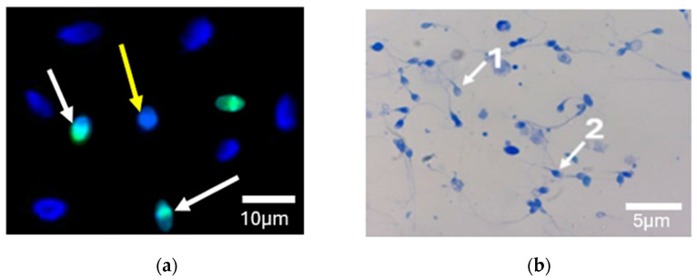 Effect of Sperm DNA Fragmentation and Chromatin Decondensation on PLCζ Efficacy in Infertile Patients.