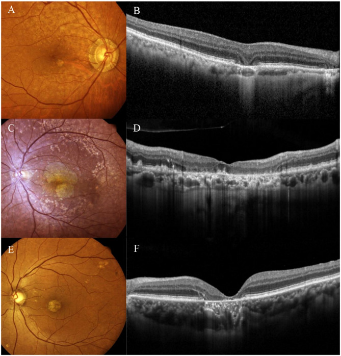 Characteristics of geographic atrophy secondary to age-related macular degeneration in Korean patients.