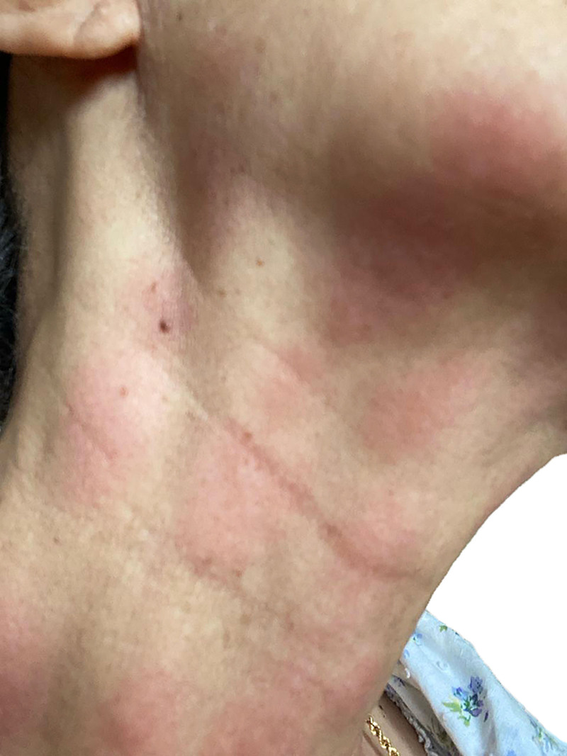 Nodule Formation Associated With Botulinum Neurotoxin Type A Injections: Potential Triggers in 23 Patients.