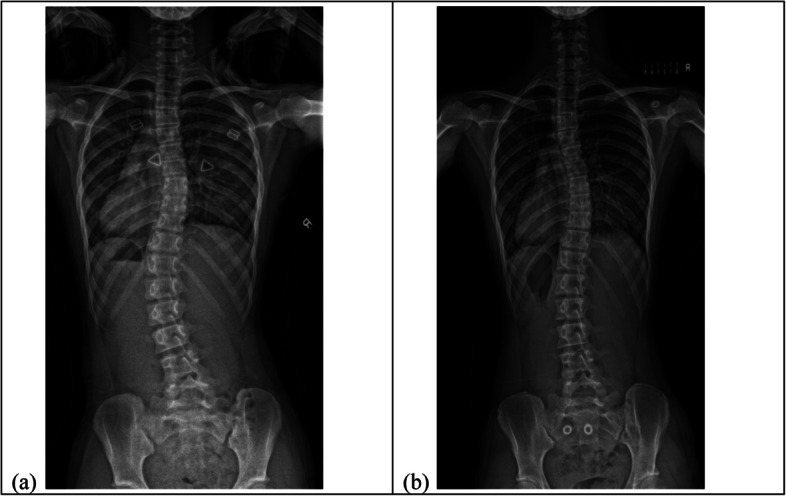 How the curve morphology differs between curve types in patients with adolescent idiopathic scoliosis during brace treatment?