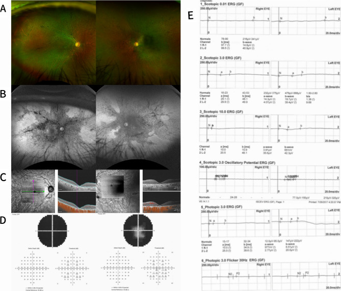 Autoimmune retinopathy in patients with myasthenia gravis: cases series and literature review.