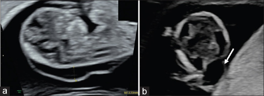 A Pattern of Malformations in the First Trimester Ultrasound.