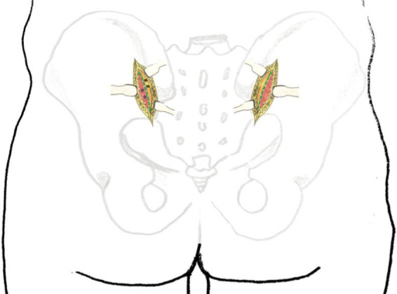 Posterior pelvic ring fixation: evolution of surgical approaches and evidence-based outcomes for unstable fractures.