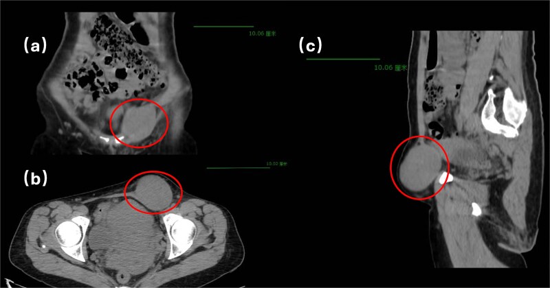 Adenomyoma of the round ligament of the uterus in the inguinal canal: a case report.