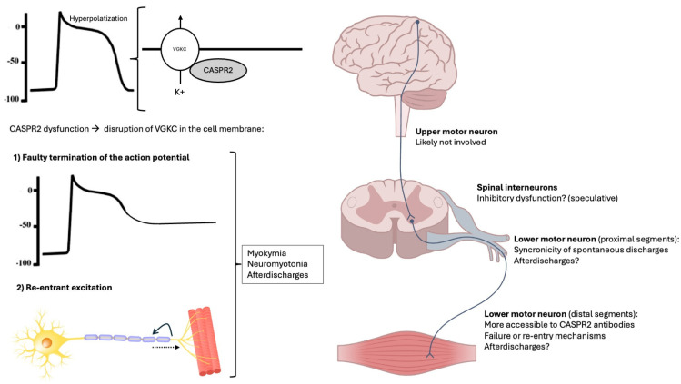 Neuromyotonia and CASPR2 Antibodies: Electrophysiological Clues to Disease Pathophysiology.