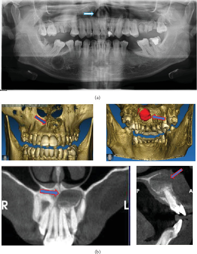 Combination of Platelet-Rich Fibrin and Carbonate Hydroxyapatite for Bone Regeneration in the Management of Radicular Cyst: A Case Report.