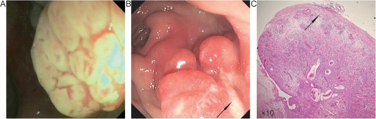 Current Status of Diagnosis and Treatment of Cap Polyposis: Insights From Chinese Studies and Comparative Analysis with Japanese Cases.