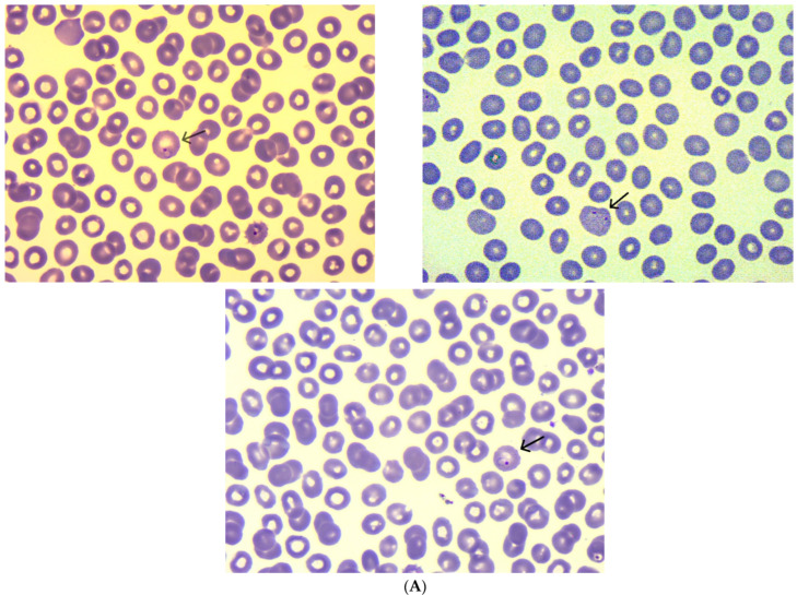 Recurrent Malaria with <i>Plasmodium vivax</i>: A Case Report and Brief Review of the Literature.