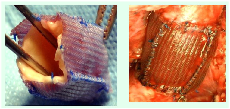 Suture Materials: Conventional and Stimulatory-Responsive Absorbable Polymers with Biomimetic Function.