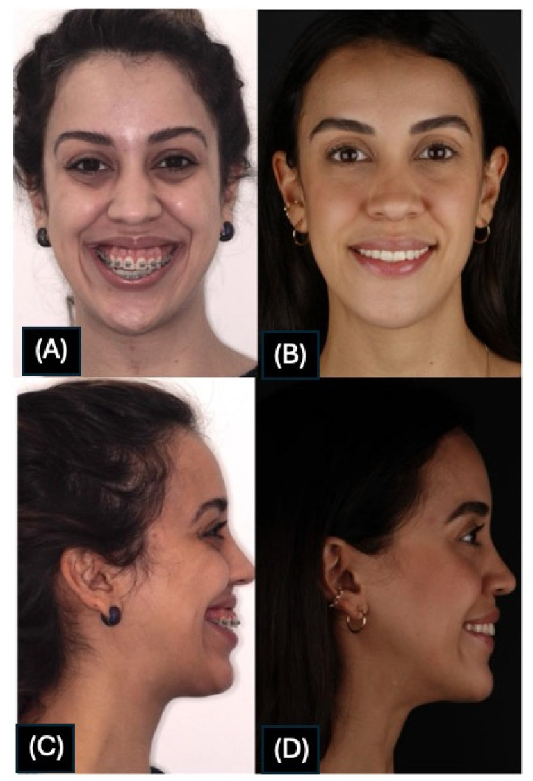 Evaluation of the Upper Airway in Class II Patients Undergoing Maxillary Setback and Counterclockwise Rotation in Orthognatic Surgery.